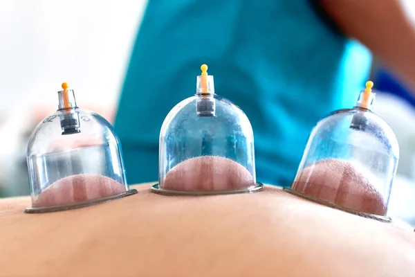 Cupping therapy using suction to increase circulation and promote recovery