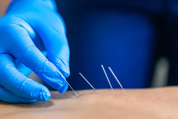 Dry needling technique targeting muscle knots and trigger points for pain relief